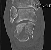 Calcaneal Fracture Sanders 2